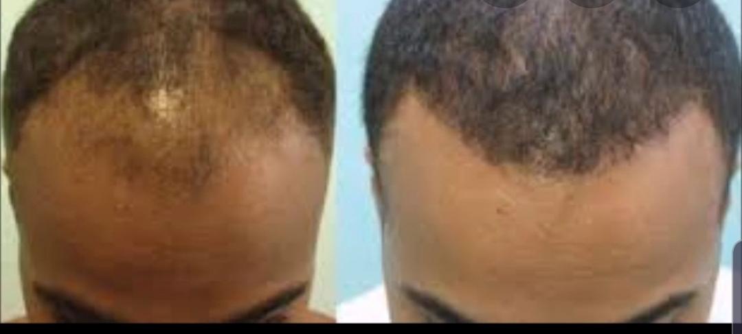 Hair Growth Serum